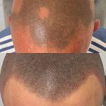 Alopecia Scalp Tattooing