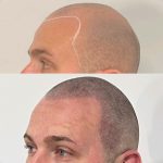 Male Scalp Tattooing